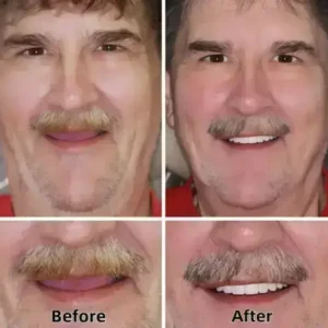 –Advanced Custom-Fit Functional Dentures - Image 6