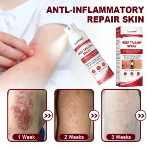 𝗕𝗲𝗲𝗳 𝗧𝗮𝗹𝗹𝗼𝘄 𝗦𝗽𝗿𝗮𝘆 𝗳𝗼𝗿 𝗜𝘁𝗰𝗵𝘆, 𝗙𝗹𝗮𝗸𝘆 𝗣𝘀𝗼𝗿𝗶𝗮𝘀𝗶𝘀 𝗦𝗸𝗶𝗻 - Image 2