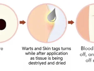 Bee Venom Wart & Tag Removal Cream - Image 10