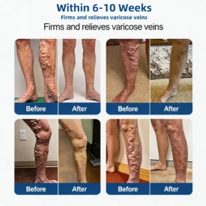 Vein Contour Microneedle Patch with Advanced Diosmin & Hesperidin Delivery🌿 — 7-Day Visible Results for Varicose Veins - Image 3