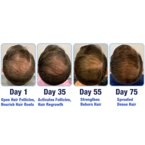 PotentGRO Hair Treatment Roller - Image 3