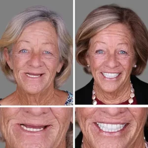 Full Denture with Strong Suctiond Custom-Fit Full Functional Dentures - Image 10
