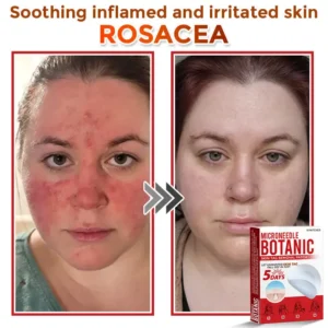 MicroNeedle Botanic Skin Tag Removal Patch - Image 3
