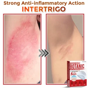 MicroNeedle Botanic Skin Tag Removal Patch - Image 7
