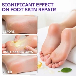 🎁 Limited-Time Offer 🎁 - Don't miss out!Tea Tree Oil Foot Cream (Repairs Dry Cracked Heels, Soothes Tired Feet, Eliminates Odor & Restores Soft Skin) - Image 6
