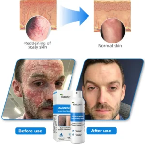 🇭✅ Official Magnesium Herbal Spray – Fast Relief for Psoriasis & Eczema | No-Rub, Steroid-Free - Image 5