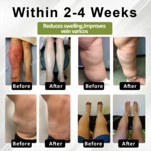 VeinoRoll Therapy Edema Comfort Cream - Image 3