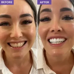 Novora Purple Teeth Whitening Strips - Image 11
