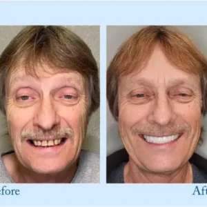 – Premium-Zahnprothese - Image 8