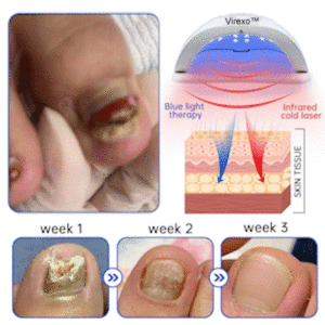 PureNail Fungus Laser Device - Image 2