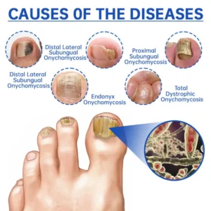 PureNail Fungus Laser Device - Image 7