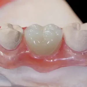 Premium Denture - Image 5