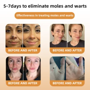 Bee Venom Wart & Tag Removal Cream - Image 6