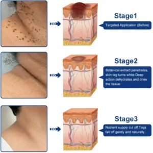 Targeted Skin Tag & Wart Removal Cream – Time-Released Phyto-Exfoliant (12% Celandine ) & Bio-Active Terpene Viral-Inhibitor (8% Thuja) - Image 2
