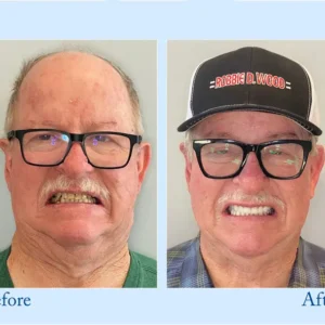 Custom-Fit Functional Dentures — Perfectly Fitted in Minutes at Home - Image 13