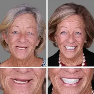 ⏰Ends Today: 70% OFF! Custom-Fit Dentures— Designed for Comfort and a Natural-Looking Smile - Image 10