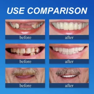 --Ends Today: 75% OFF! Full Denture with Strong Suctiond Custom-Fit Full Functional Dentures🦷 - Image 6