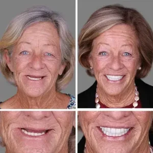 Custom Dentures 2026 | Secure Natural Fit - Image 10
