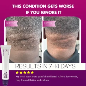 Keloid & Raised Scar Removal Cream | Alisanda 2026 - Image 5