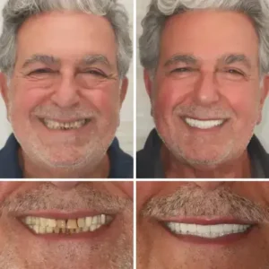 【Official Brand Store】Custom-Fit Functional Dentures — ComfortMax Edition - Image 10