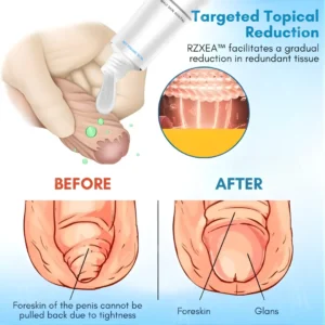 Foreskin Elasticity Gel 2026 | Non-Surgical Relief - Image 3