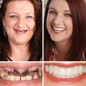 🦷Custom-Fit Dentures | Smile with Confidence - Image 10
