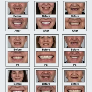 🏆Ends Today: 70% OFF! 🏆2026 Bestselling Product🦷 Fit for a Fresh Smile, Say Goodbye to Wearing Discomfort! - Image 3