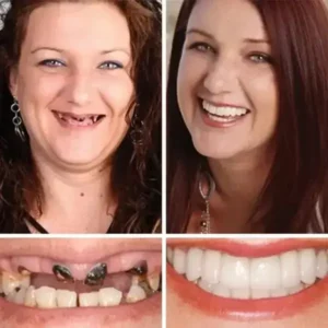 -Ends Today: 70% OFF! Full Denture with Strong Suctiond Custom-Fit Full Functional Dentures🦷 - Image 6