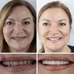 ⏰Ends Today: 70% OFF! Custom-Fit Dentures— Designed for Comfort and a Natural-Looking Smile - Image 12