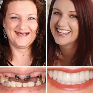 –Ends Today: 75% OFF! Full Denture with Strong Suctiond Custom-Fit Full Functional Dentures🦷 - Image 10