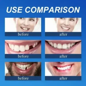 –Ends Today: 75% OFF! Full Denture with Strong Suctiond Custom-Fit Full Functional Dentures🦷 - Image 6