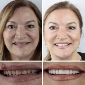 Premium Denture 2026 | Custom Fit Denture - Image 10