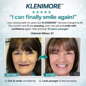 Complete Dentures 2026 | Natural Fit Smile - Image 5