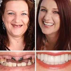 🏆Ends Today: 70% OFF! 🏆2026 Bestselling Product🦷 Fit for a Fresh Smile, Say Goodbye to Wearing Discomfort!🌎 - Image 11