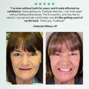 Custom-Fit Functional Dentures - Image 5