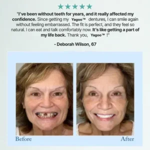🦷Advanced Customized Full Denture Set🦷 (🔥10,000+ Sold In Last 30 Day) - Image 7