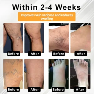 MicroSting Bee Vein Ease Patches - Image 3