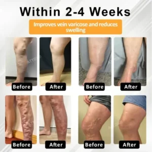 MicroSting Bee Vein Ease Patches - Image 3