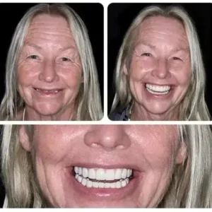 -Custom-Fit Functional Dentures - Image 3