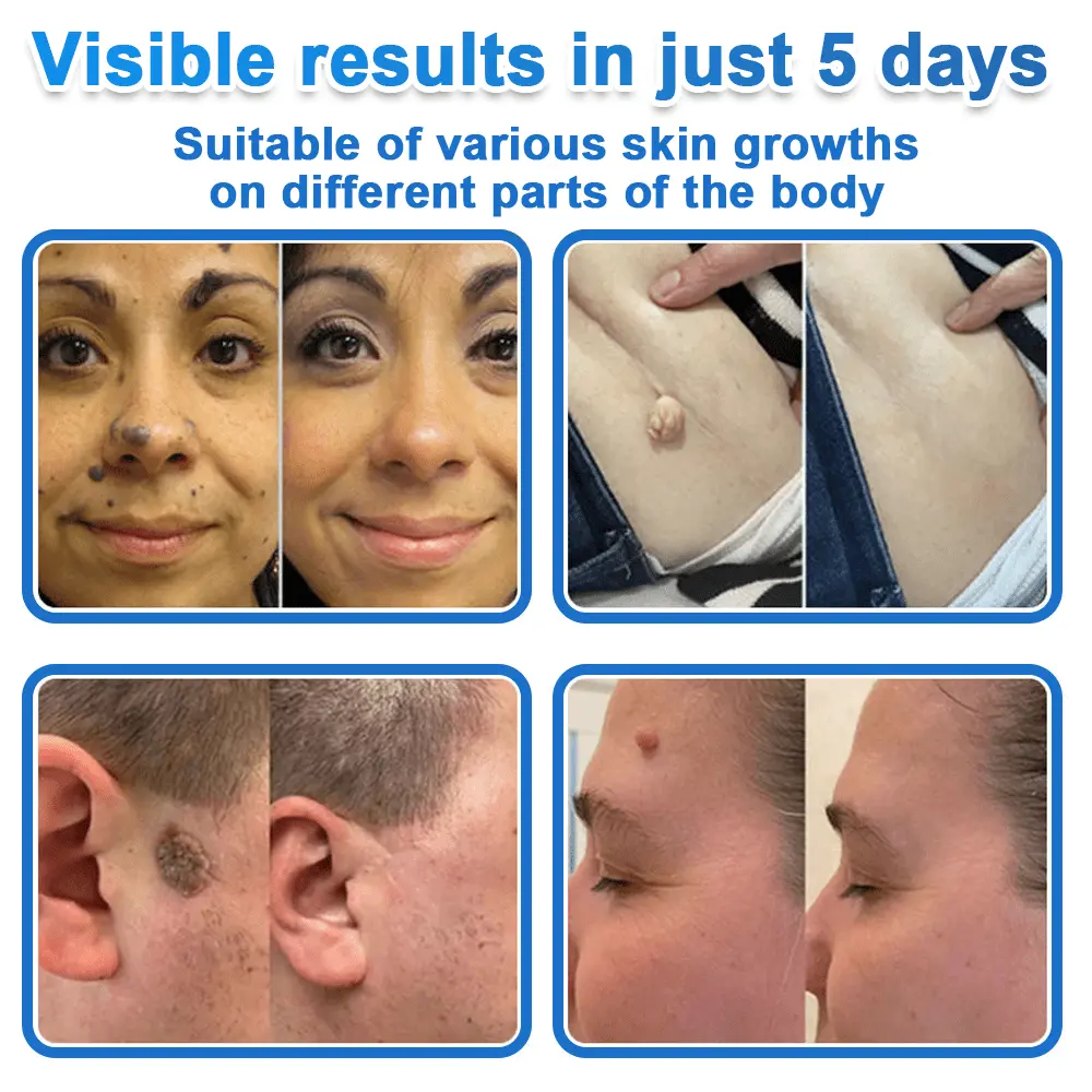 2-in-1 Microneedle + Hydrocolloid Skin Patch Repair System - Image 2