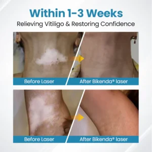 Vitiligo Therapy Device - Image 10