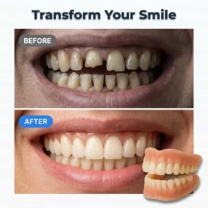 Custom Fit Denture Set | Adhesive-Free Suction Fit Dentures - Image 3