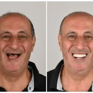 Custom-Fit Dentures | Self-Molding & Natural Smile - Image 2