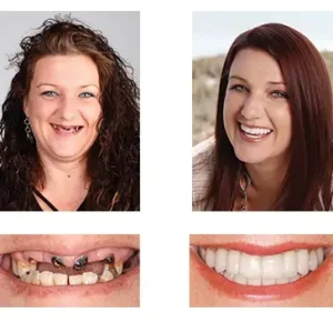 Custom-Fit Dentures | Self-Molding & Natural Smile - Image 5