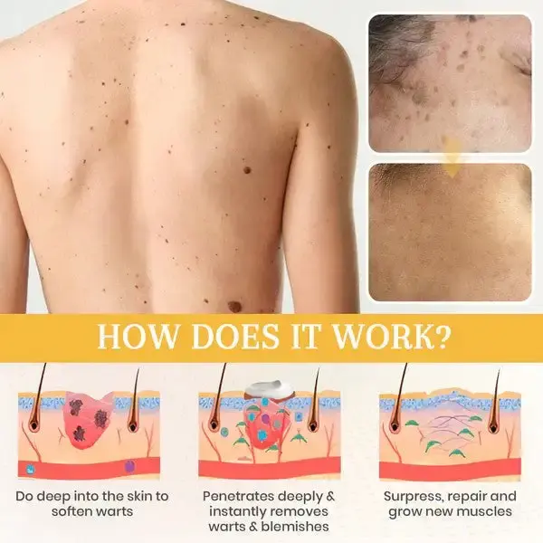 DermaErase Advanced Mole & Spot Removal Gel - Image 4