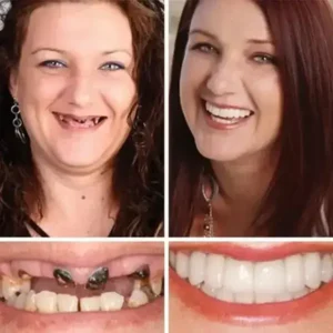 Premium Full Denture Set - Image 11