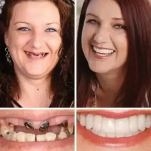 Premium Full Denture Set - Image 11
