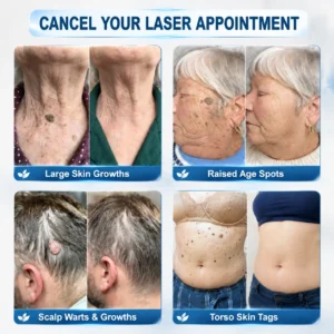 7-Day Skin Tag & Spot Eraser Painless & Scar-Free Advanced Skin Renewal Roller Pen - Image 2