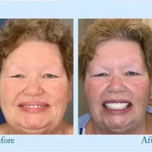 Dentures - Image 11