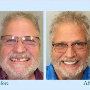 Dentures - Image 11